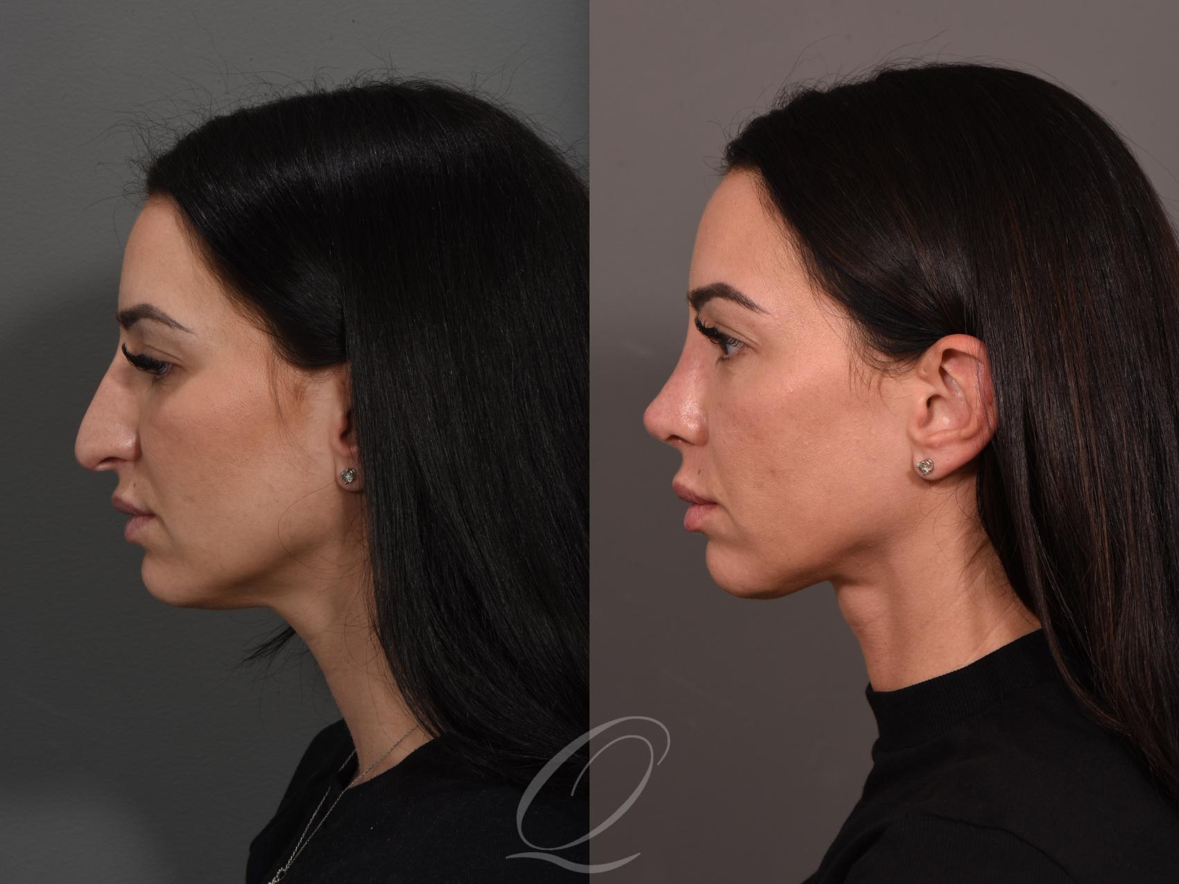 SMAS Facelift Results: A Comparative Look at Before and After